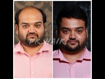 Best Hair replacement in Chennai | Tamilnadu | Non surgical hair bonding | Hair fixing | Hair patch