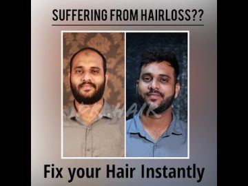 Hair replacement in Chennai | Hair fixing | Non surgical hair bonding | Hair patch | Hair Bonding