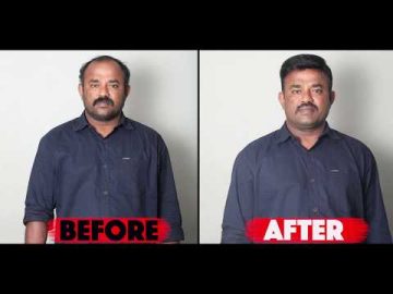 Non surgical | Hair replacement in Chennai | Tamilnadu | Non surgical hair bonding | Hair fixing |